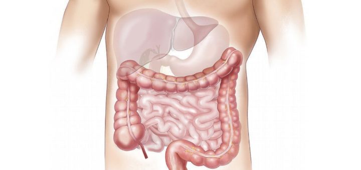 cáncer de colon